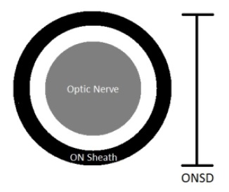 ONSD Diagram