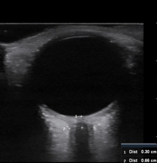 Enlarge ONSD Ultrasound
