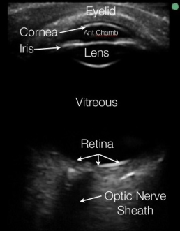 Ocular Ultrasound with Labels