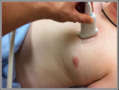 Figure 9 – Lung Ultrasound Probe Position (from ICMteaching.com) 